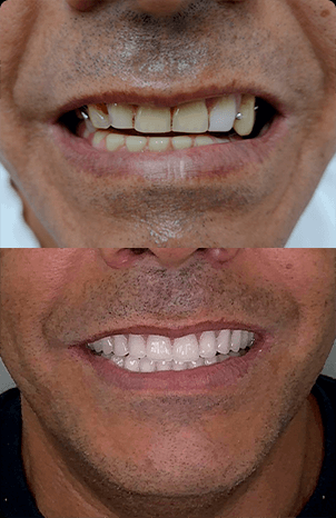 Registro comparativo de um sorriso fornecido pelo consultório