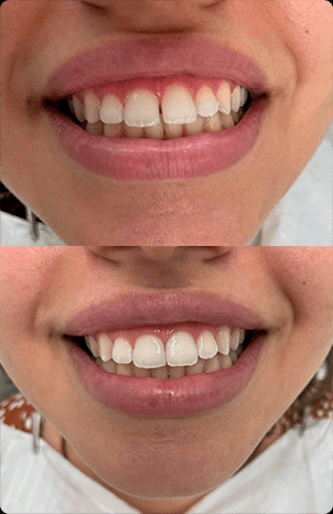 Registro clínico de sorriso em duas imagens